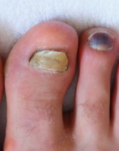 Green under the toenail Pseudomonas nail infection