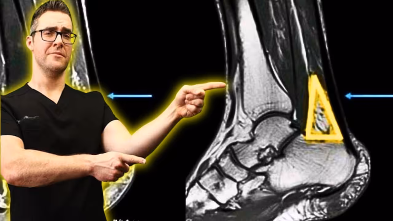 Kager’S Triangle Fat Pad | Balance Foot & Ankle