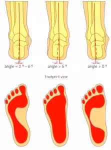pronated vs. supinated heel pain