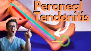 Peroneal Tendonitis Treatment