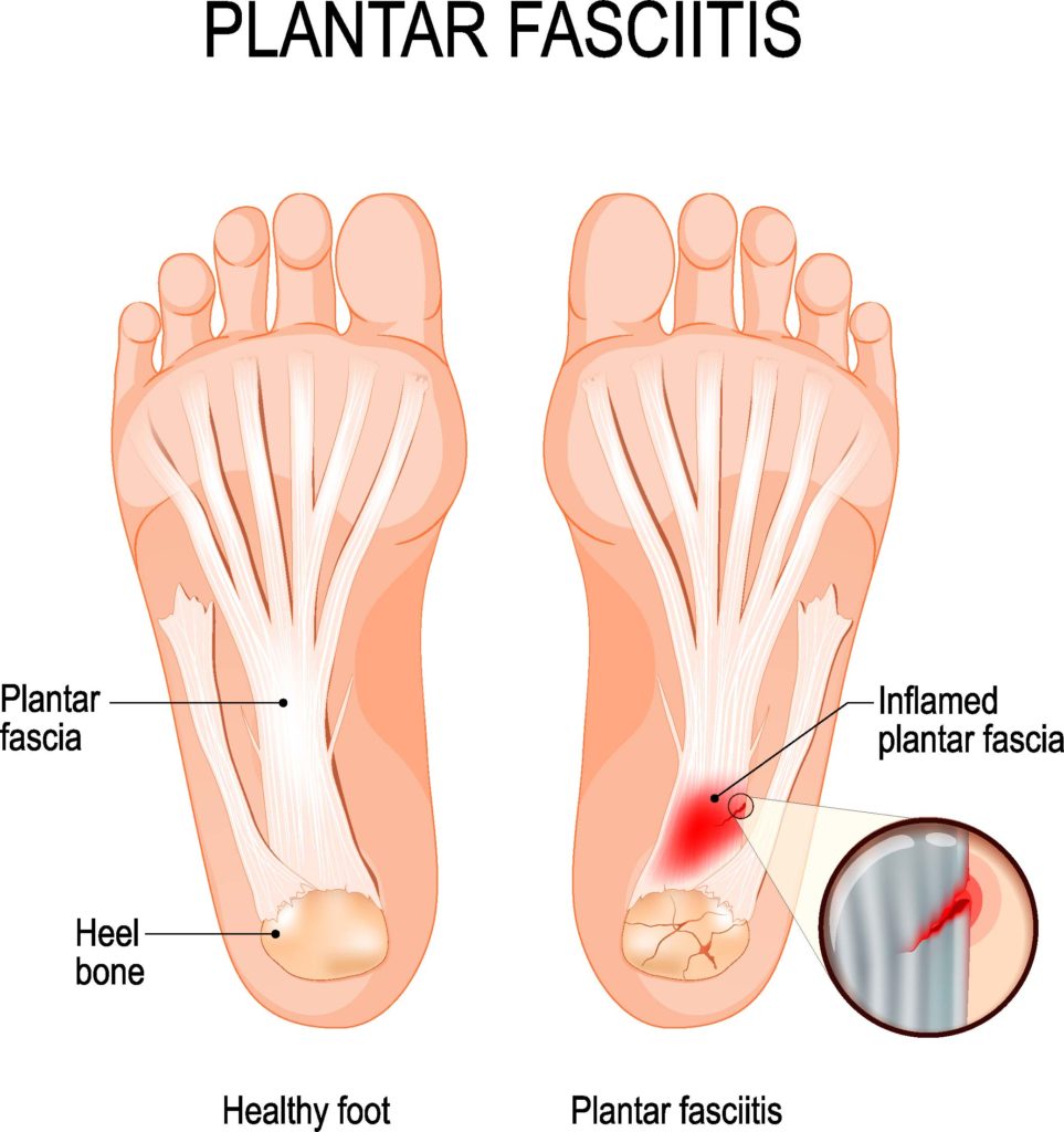 plantar fasciitis injury pain