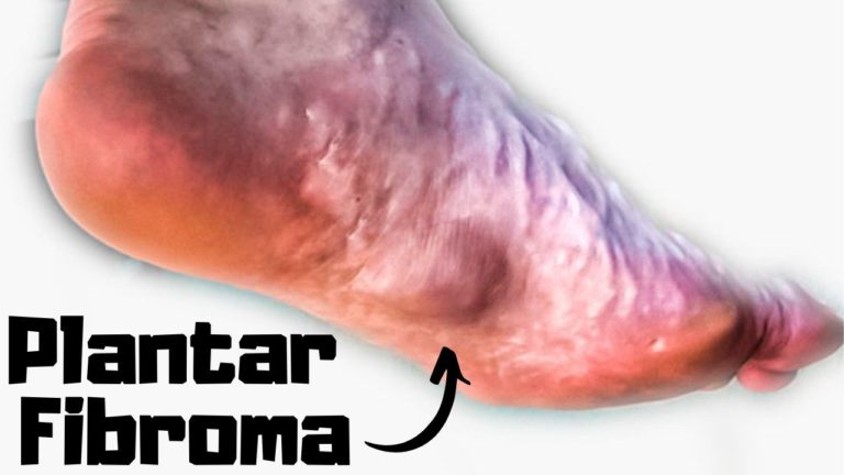 Plantar Fibroma Causes & Treatment