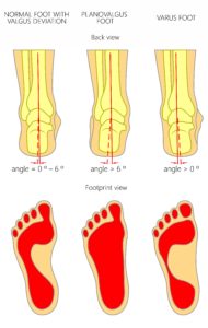 pronated foot vs supinated foot heel pain