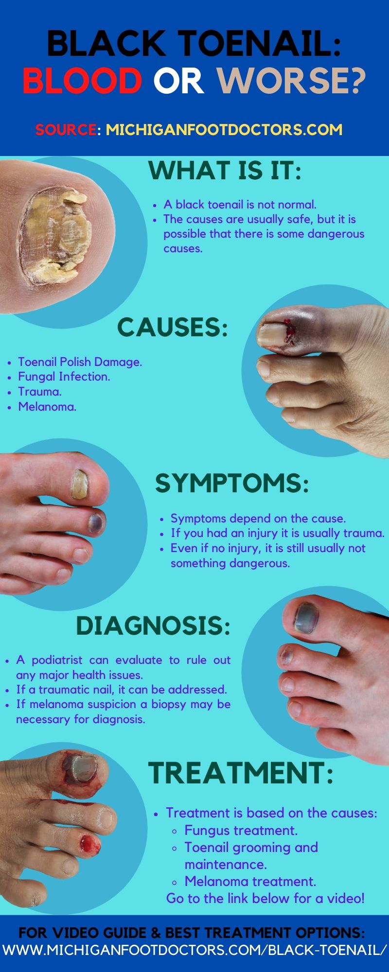 Black Toenail Infection