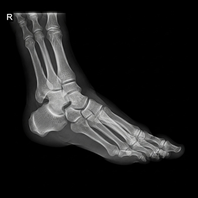 Normal Foot X ray