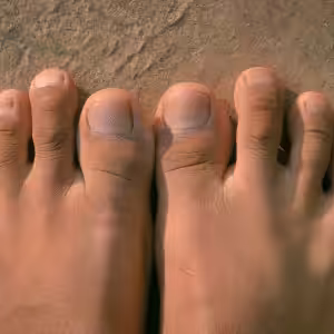 Capsulitis of the Second Toe Taping