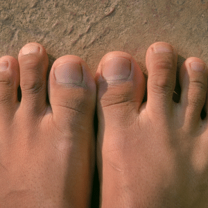 Capsulitis of the Second Toe Taping