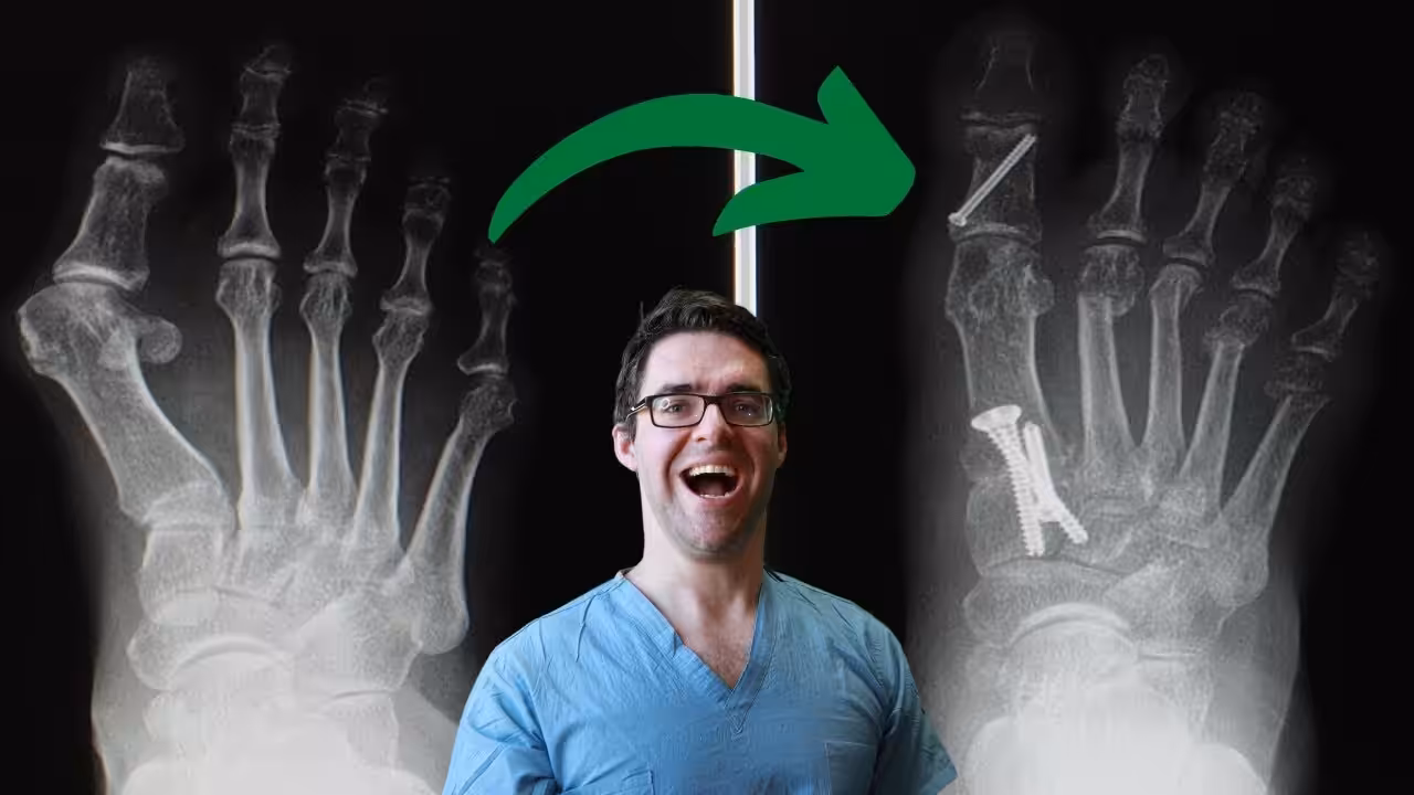 Big Toe Joint Pain Replacement Recovery Time