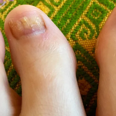 white chalky toenail from nail polish