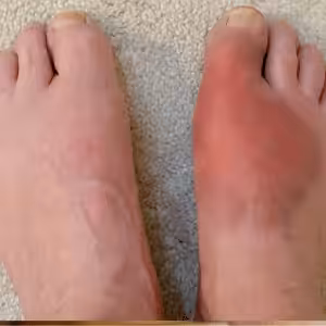 gout on top of foot
