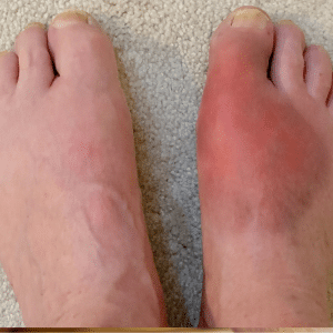 gout on top of foot