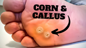 corn callus