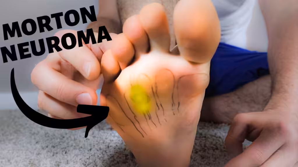 Morton Neuroma Compression Best treatment 2020