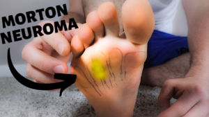 Morton Neuroma Compression Best treatment 2020