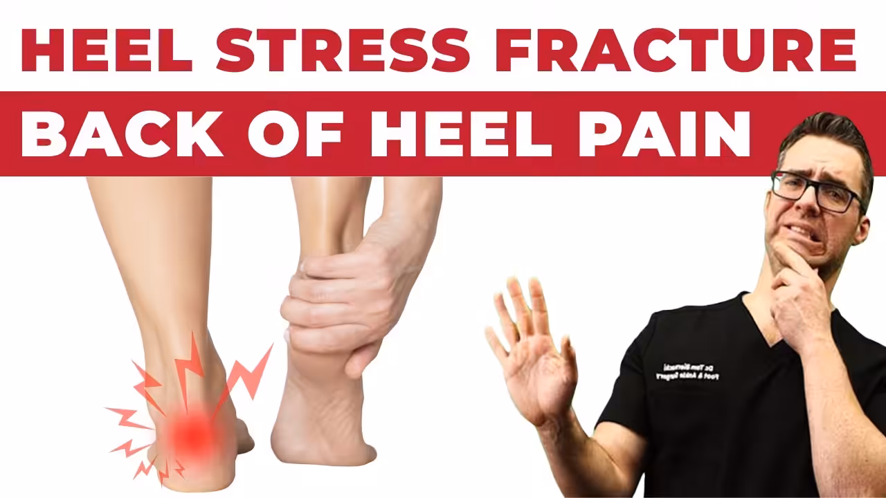 Calcaneal stress fracture X-ray diagram — foot fracture diagnosis at Balance Foot  Ankle Michigan
