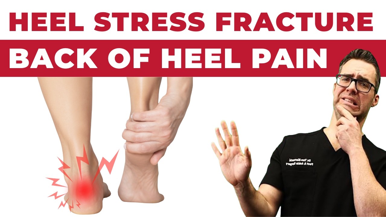 Calcaneal stress fracture X-ray diagram — foot fracture diagnosis at Balance Foot & Ankle Michigan