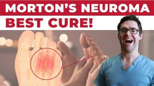 Morton's neuroma surgery recovery timeline — podiatric surgery at Balance Foot & Ankle Howell MI