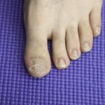 White Chalky toenails after removing toenail polish.