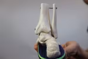 High ankle sprain recovery time of ligament tear