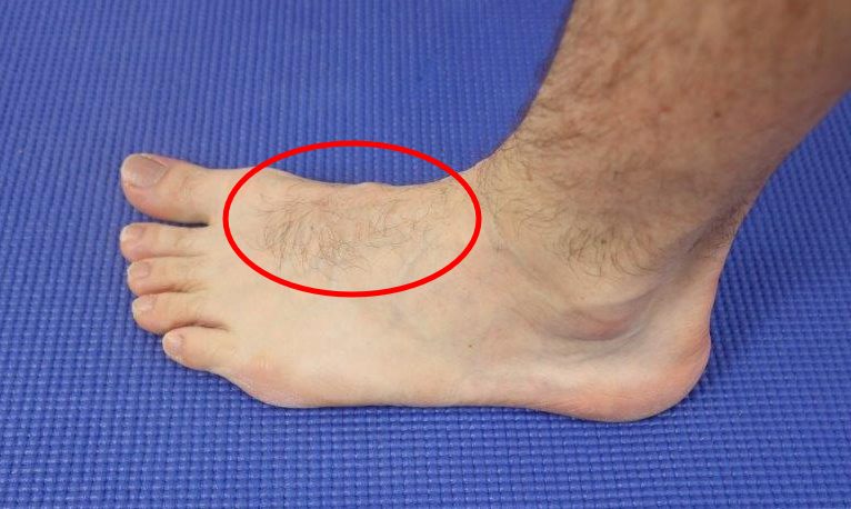 Top Of Foot Swollen Causes Symptoms Best Home Treatment