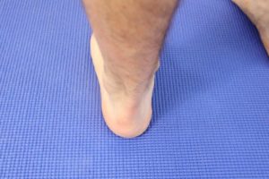 back of the heel Achilles tendonitis pain ESWT treatment