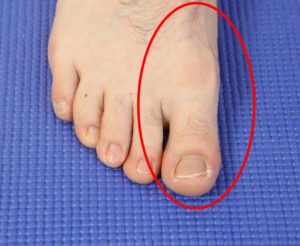 Foot Pain Behind Big Toe: Causes, Symptoms & Best Treatment 2020