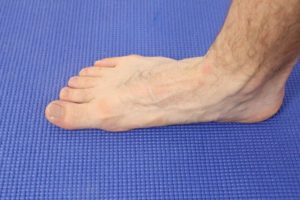 Flat foot surgery recovery time 3 Flat Foot Surgery Recovery Time: Best Treatment, Boots & Shoes