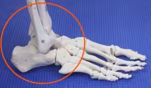 Ankle Ligament sprain on the outside of the ankle