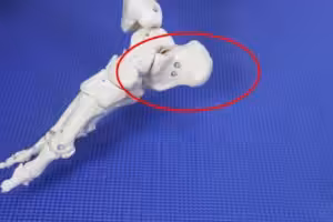 Cracked Heel Bone Fracture Surgery Recovery Time