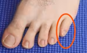 Pinky toe and 5th toe pain