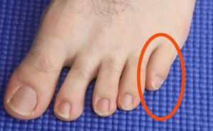 Pinky toe, 5th toe pain and little toe pain