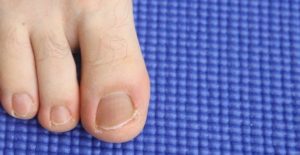 Ingrown Toenail Pain