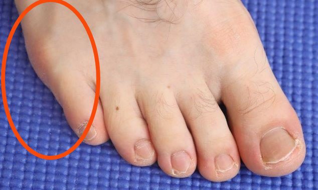 Sprained Little Toe How To Tell If Broken Best Treatment