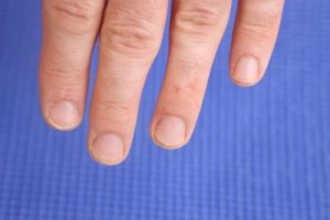 Fingernail free of nail fungus: No thick yellow fingernails