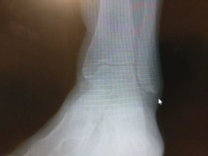 Bruised Ankle Bone Causes, Recovery Time & Best Treatment