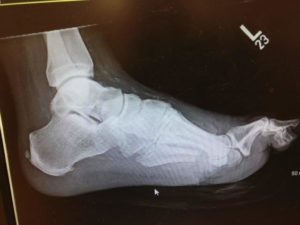 cavus foot type with charcot marie tooth surgery treatment