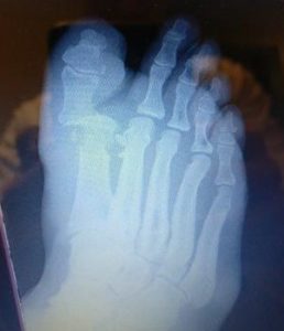 broken and dislocated big toe joint with metatarsal phalangeal joint fracture