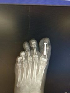 big toe joint hallux IPJ fusion surgery treatment hallux