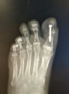 big toe joint hallux IPJ fusion surgery treatment hallux