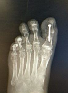 Big Toe Joint Fusion 7 big toe joint hallux IPJ fusion surgery treatment hallux