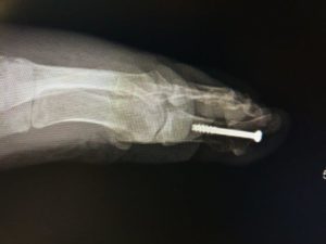 big toe joint hallux IPJ fusion surgery treatment