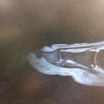 ingrown toenail MRI for bone infection ulcer and diabetes with neuropathy