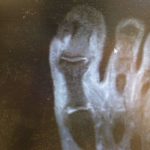 big toe joint ulcer with bone infection from ingrown toenail