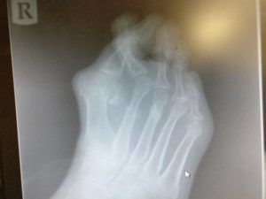Can Bunions be Reversed Without Surgery? The Best Home Treatment 2020