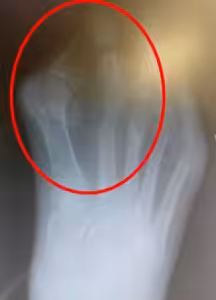 bunion cross over hammer toe