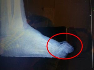 Hammer toe of the 2nd toe side view