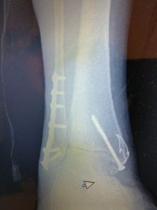 Broken ankle fixation: tibia and fibula surgery