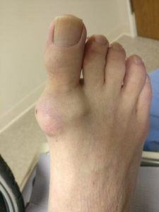 gout on top of the foot, toe foot heel ankle knee