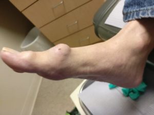 gout of the big toe joint
