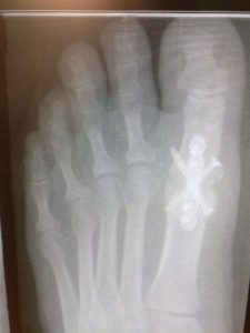 Flat foot surgery recovery time 7 big toe joint fusion1st MTPJ fusion